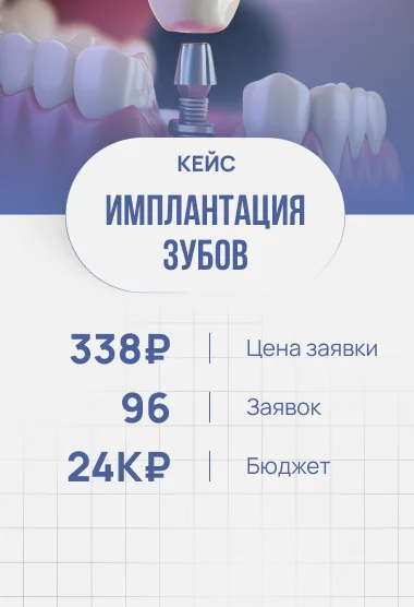 Имплантация зубов